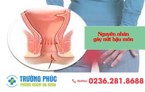Nguyên Nhân Gây Nứt Kẻ Hậu Môn Và Cách Điều Trị Hiệu Qủa