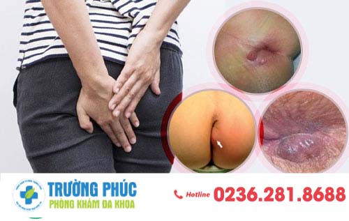 Nổi mụn nhọt hậu môn - triệu chứng cảnh báo nhiều nguy hiểm