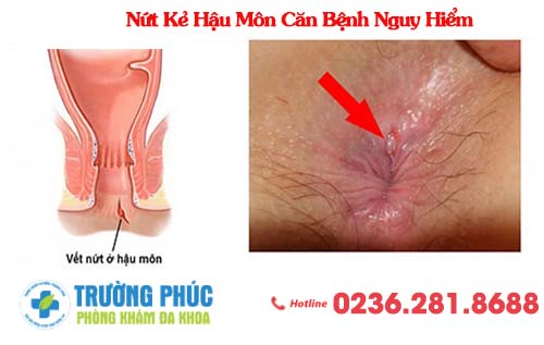 Nứt Kẻ Hậu Môn Căn Bệnh Nguy Hiểm Cần Được Điều Trị Ngay
