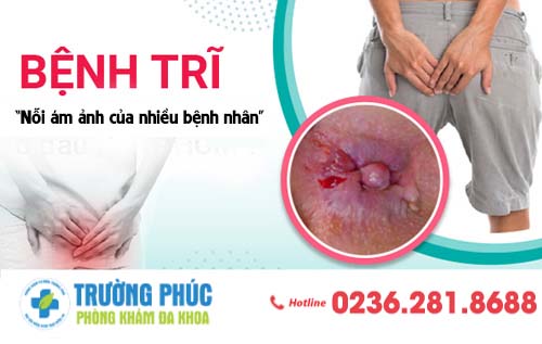 Bệnh trĩ: Dấu hiệu và cách chữa hiệu quả nhất
