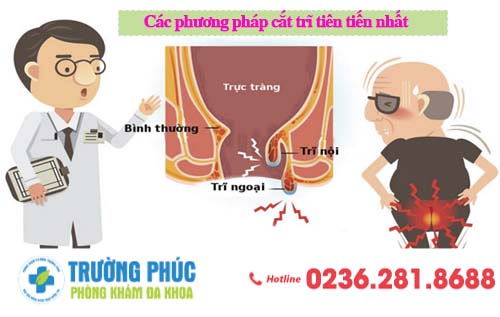 Các phương pháp cắt trĩ tiên tiến nhất hiện nay 2020
