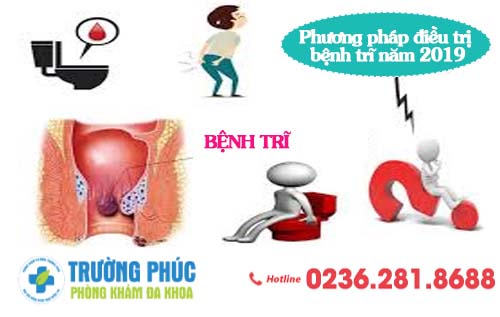 Phương pháp điều trị bệnh trĩ năm 2020