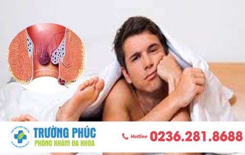 Bệnh trĩ có lây khi quan hệ không?