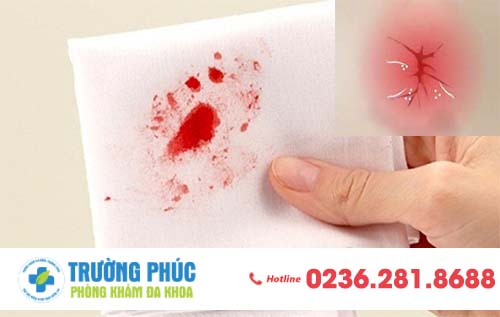 Xử Lý Nhanh Chứng Rách Hậu Môn