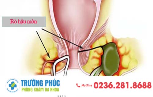 Các dấu hiệu của rò hậu môn và cách điều trị hiệu quả.