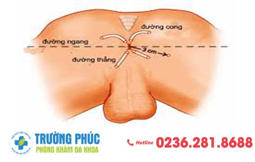 Bệnh Rò Hậu Môn Nhận Biết Sớm Để Tránh Biến Chứng