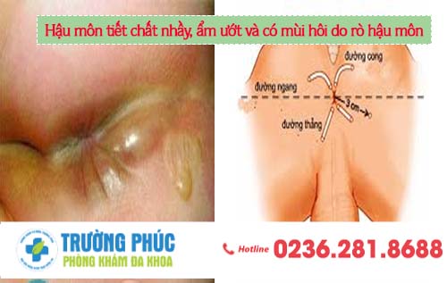 Hậu môn tiết chất nhầy, ẩm ướt và có mùi hôi là dấu hiệu của bệnh gì?