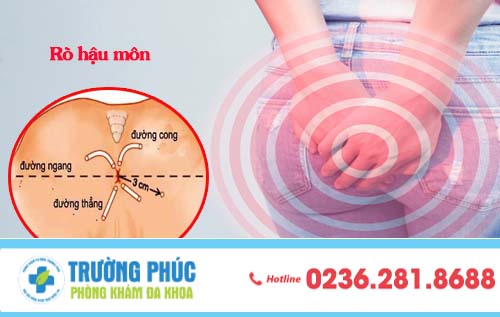 Dấu hiệu của bệnh rò hậu môn và phương pháp điều trị hiệu quả