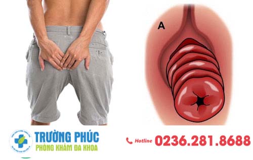 Sa hậu môn là gì? Cách điều trị như thế nào?