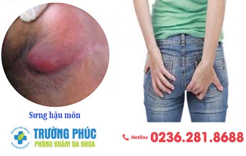 Hiện Tượng Sưng Hậu Môn Cảnh Báo Vấn Đề Gì Từ Cơ Thể?