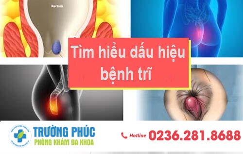 Cập nhật các thông tin bệnh trĩ cần thiết