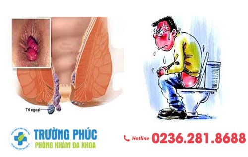 Táo bón là gì Nên điều trị táo bón ở đâu để hết bệnh nhanh chóng?