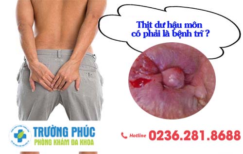 Thịt thừa hậu môn có nguy hiểm không?
