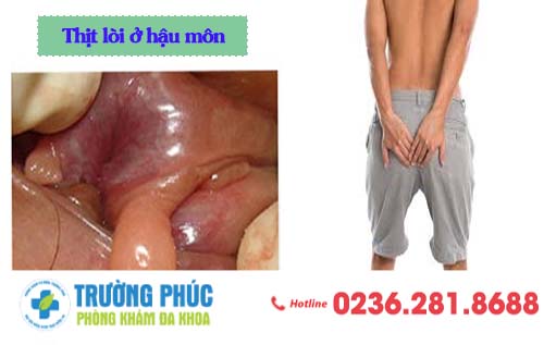 Thịt Lòi Ở Hậu Môn - Dấu Hiệu Cảnh Báo Nhiều Bệnh Lý Nguy Hiểm