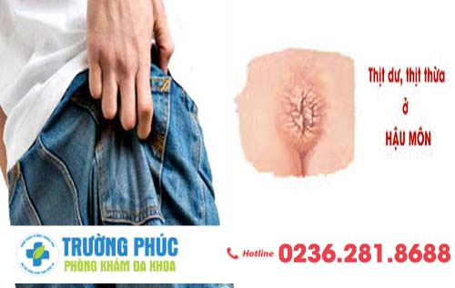 Thịt dư ở hậu môn là biểu hiện của bệnh gì?