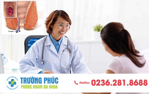 Tổng hợp kiến thức về bệnh trĩ ngoại
