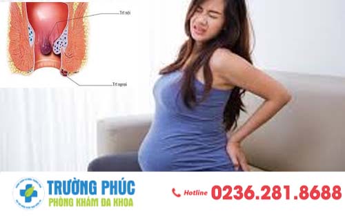 Hỗ trợ điều trị bệnh trĩ cho bà bầu