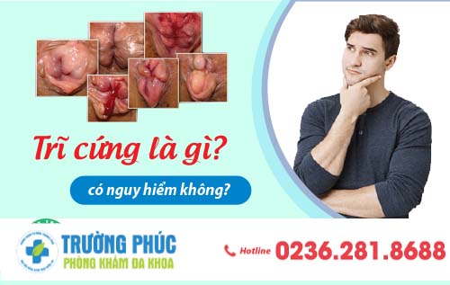 Trĩ cứng là gì? có nguy hiểm không?