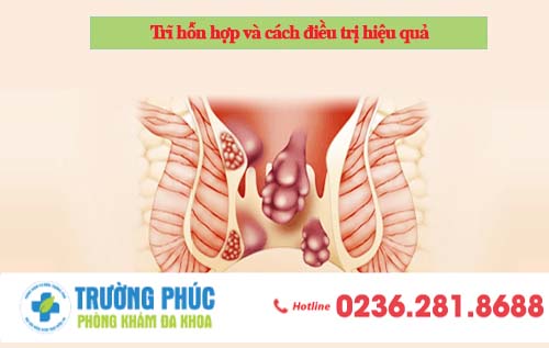 Trĩ hỗn hợp và cách điều trị hiệu quả