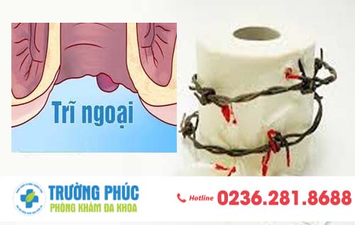 Dấu hiệu nhận biết bệnh trĩ ngoại