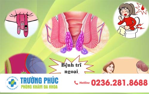 Bệnh Trĩ Ngoại Và Phương Pháp Cắt Trĩ Ngoại An Toàn Hiệu Quả 2020