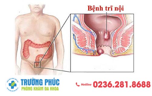 Cách nhận biết trĩ nội qua từng cấp độ