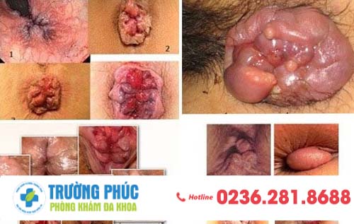 Búi trĩ sẽ sà ra ngoài hậu môn