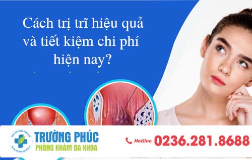 Cách trị trĩ hiệu quả và tiết kiệm chi phí hiện nay