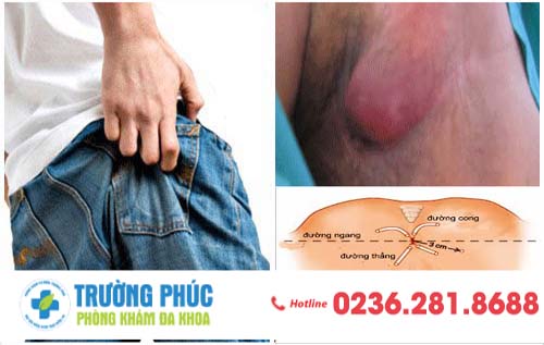 Nhận Biết Triệu Chứng Rò Hậu Môn Và Phương Pháp Điều Trị Hiệu Qủa