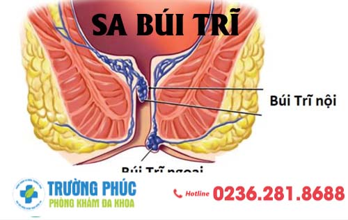 Triệu chứng Sa búi trĩ và mức độ nguy hiểm cần cảnh giác