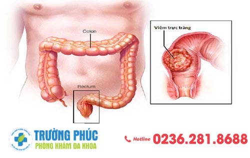 Viêm hậu môn là bệnh gì?